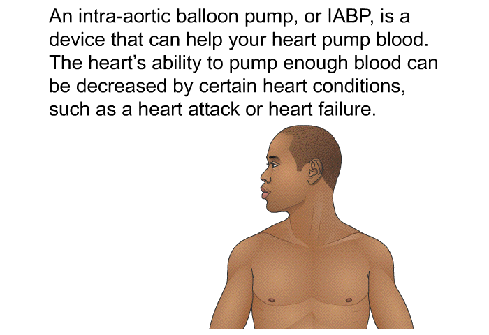 An intra-aortic balloon pump, or IABP, is a device that can help your heart pump blood. The heart's ability to pump enough blood can be decreased by certain heart conditions, such as a heart attack or heart failure.