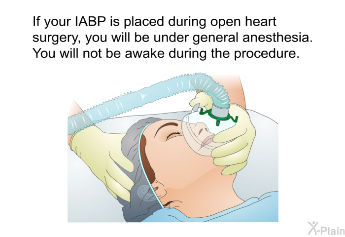 If your IABP is placed during open heart surgery, you will be under general anesthesia. You will not be awake during the procedure.