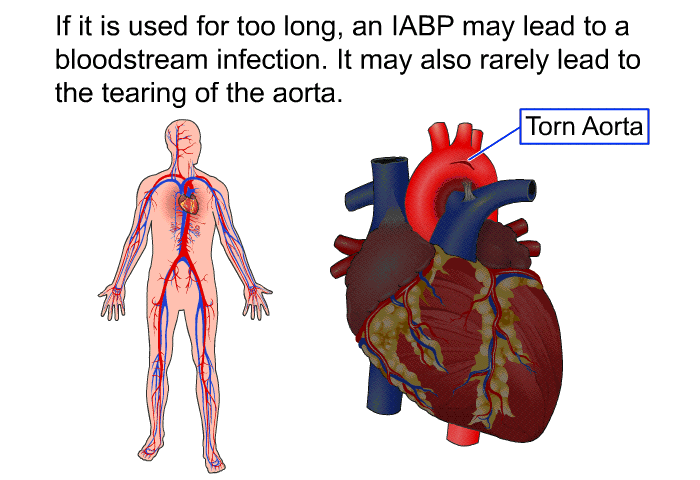 If it is used for too long, an IABP may lead to a bloodstream infection. It may also rarely lead to the tearing of the aorta.