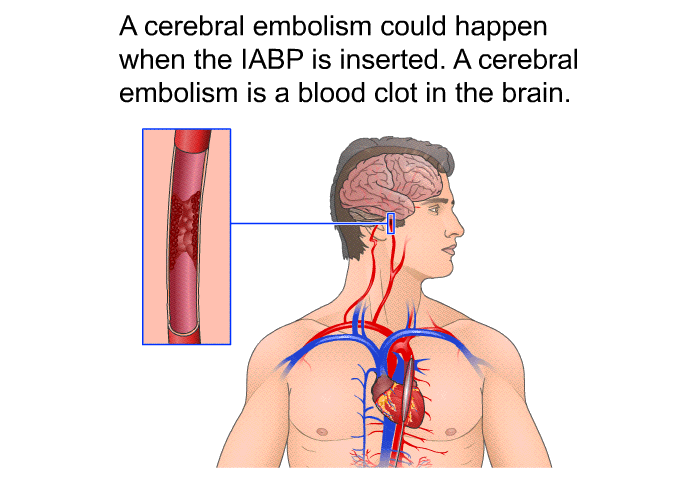 A cerebral embolism could happen when the IABP is inserted. A cerebral embolism is a blood clot in the brain.