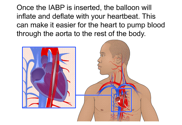 Once the IABP is inserted, the balloon will inflate and deflate with your heartbeat. This can make it easier for the heart to pump blood through the aorta to the rest of the body.