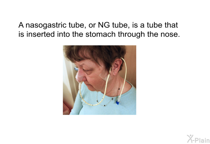 A nasogastric tube, or NG tube, is a tube that is inserted into the stomach through the nose.