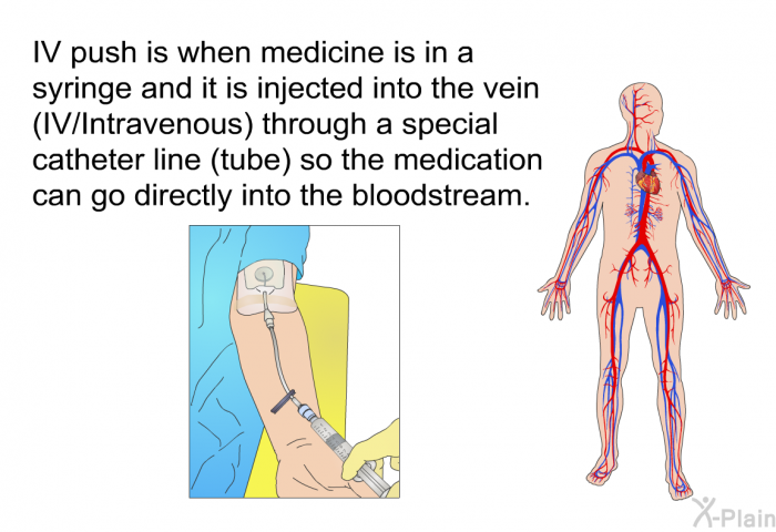 IV push is when medicine is in a syringe and it is injected into the vein (IV/Intravenous) through a special catheter line (tube) so the medication can go directly into the bloodstream.