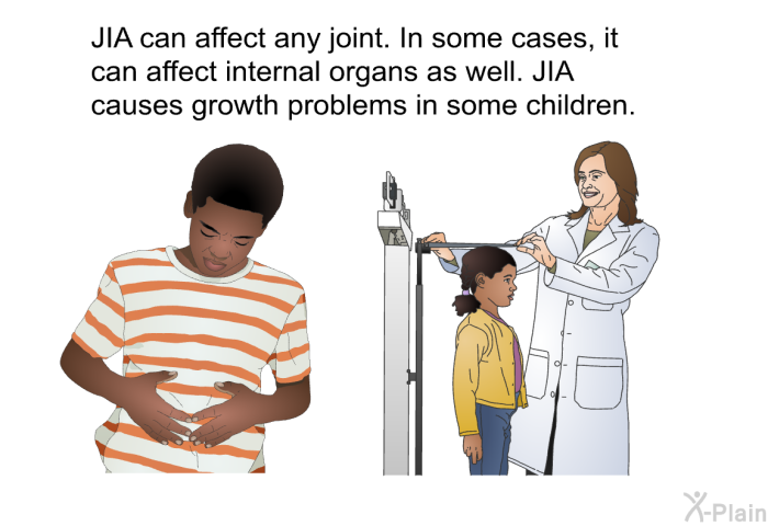 JIA can affect any joint. In some cases, it can affect internal organs as well. JIA causes growth problems in some children.