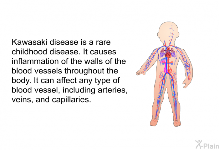 Kawasaki disease is a rare childhood disease. It causes inflammation of the walls of the blood vessels throughout the body. It can affect any type of blood vessel, including arteries, veins, and capillaries.