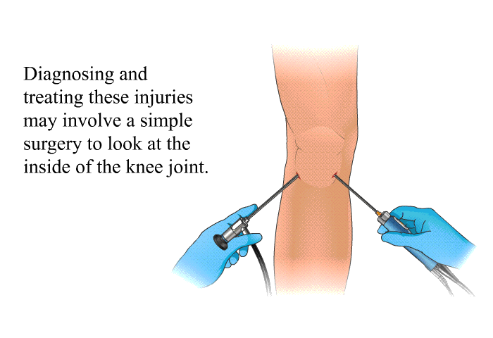 Diagnosing and treating these injuries may involve a simple surgery to look at the inside of the knee joint.