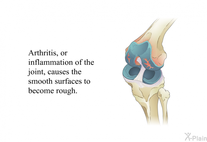 Arthritis, or inflammation of the joint, causes the smooth surfaces to become rough.
