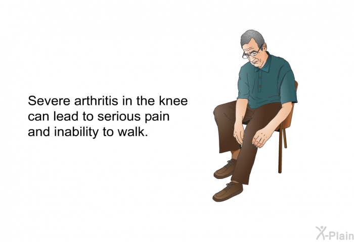 Severe arthritis in the knee can lead to serious pain and inability to walk.