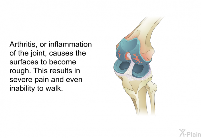 Arthritis, or inflammation of the joint, causes the surfaces to become rough. This results in severe pain and even inability to walk.