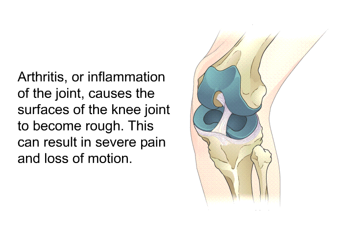 Arthritis, or inflammation of the joint, causes the surfaces of the knee joint to become rough. This can result in severe pain and loss of motion.