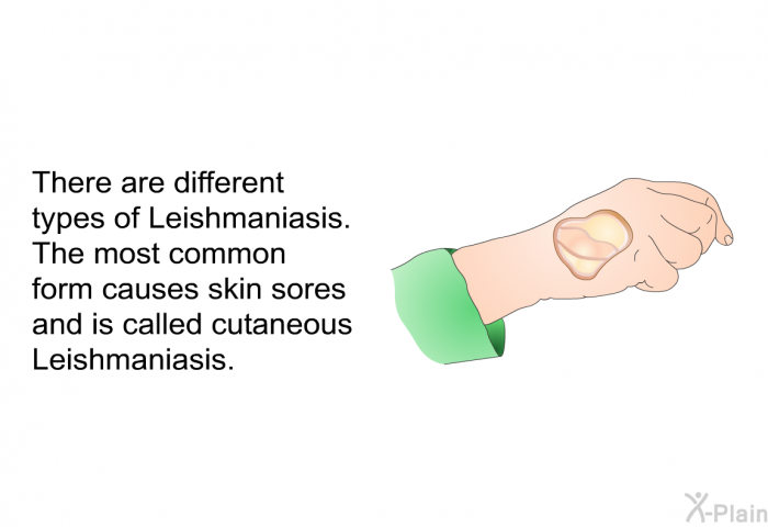 There are different types of Leishmaniasis. The most common form causes skin sores and is called cutaneous Leishmaniasis.