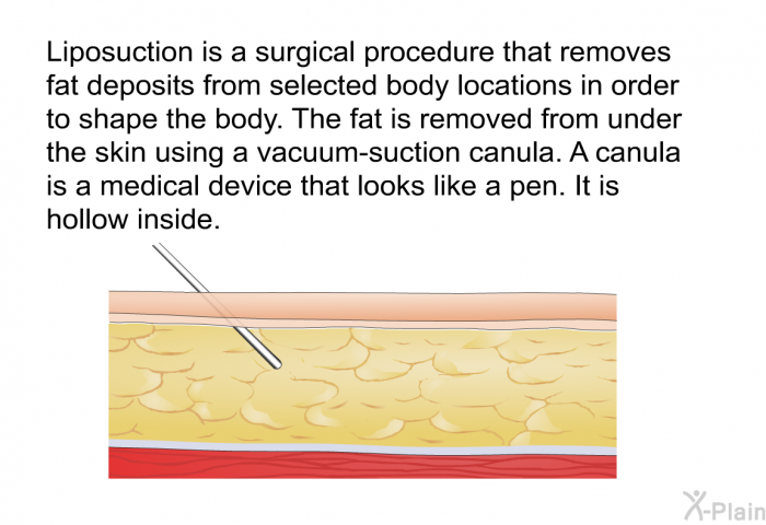 Liposuction is a surgical procedure that removes fat deposits from selected body locations in order to shape the body. The fat is removed from under the skin using a vacuum-suction canula. A canula is a medical device that looks like a pen. It is hollow inside.