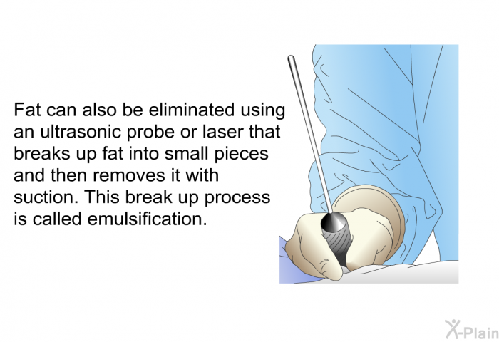 Fat can also be eliminated using an ultrasonic probe or laser that breaks up fat into small pieces and then removes it with suction. This break up process is called emulsification.