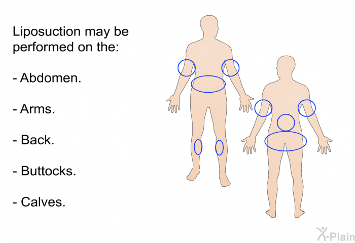 Liposuction may be performed on the:  Abdomen. Arms. Back. Buttocks. Calves.