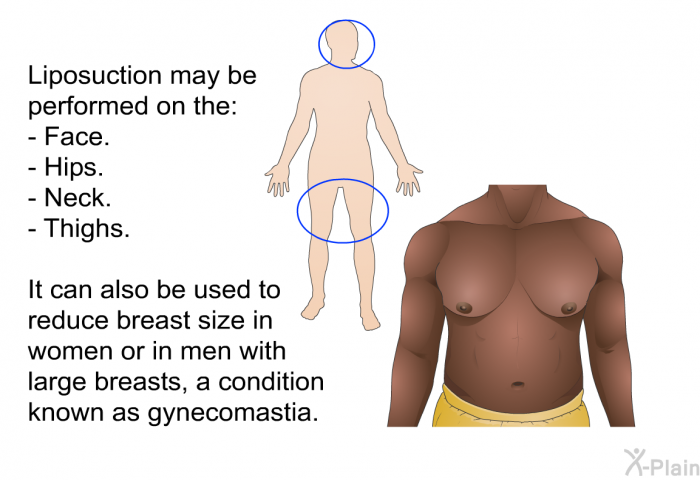 Liposuction may be performed on the:  Face. Hips. Neck. Thighs.  
 It can also be used to reduce breast size in women or in men with large breasts, a condition known as gynecomastia.