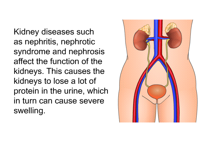 Kidney diseases such as nephritis, nephrotic syndrome and nephrosis affect the function of the kidneys. This causes the kidneys to lose a lot of protein in the urine, which in turn can cause severe swelling.