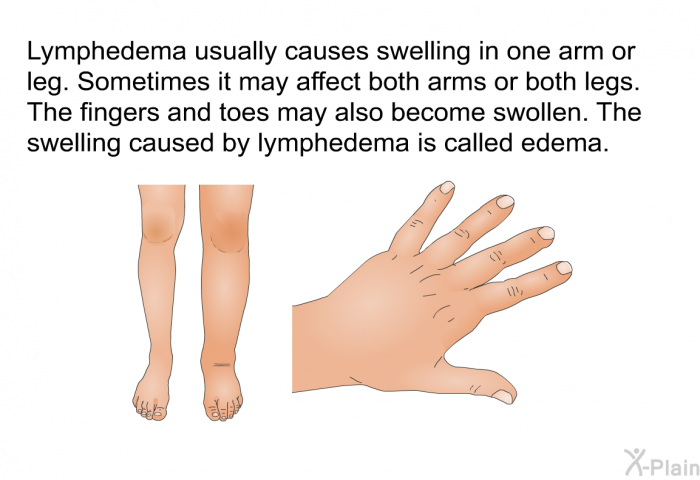 Lymphedema usually causes swelling in one arm or leg. Sometimes it may affect both arms or both legs. The fingers and toes may also become swollen. The swelling caused by lymphedema is called edema.