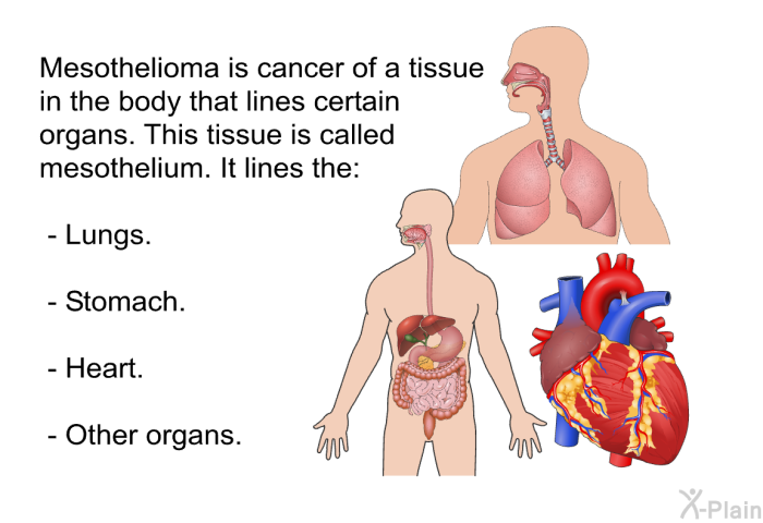 Mesothelioma is cancer of a tissue in the body that lines certain organs. This tissue is called mesothelium. It lines the:  Lungs. Stomach. Heart. Other organs.
