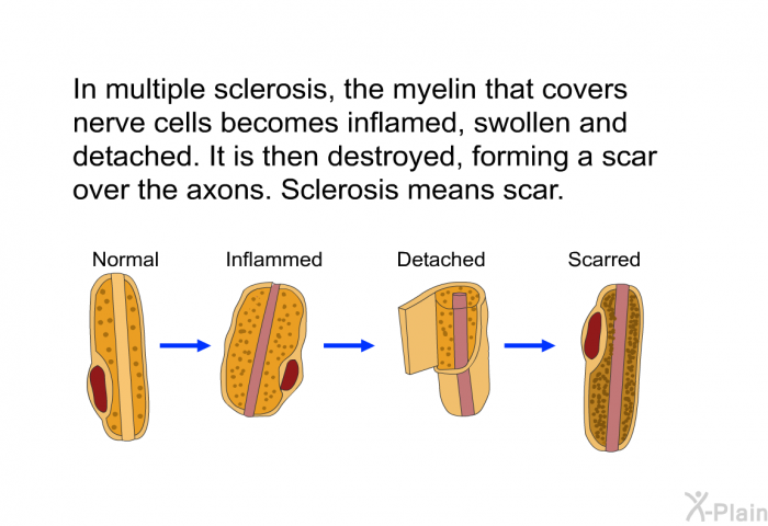 In multiple sclerosis, the myelin that covers nerve cells becomes inflamed, swollen and detached. It is then destroyed, forming a scar over the axons. Sclerosis means scar.