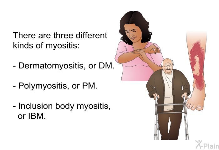 There are three different kinds of myositis:  Dermatomyositis, or DM. Polymyositis, or PM. Inclusion body myositis, or IBM.