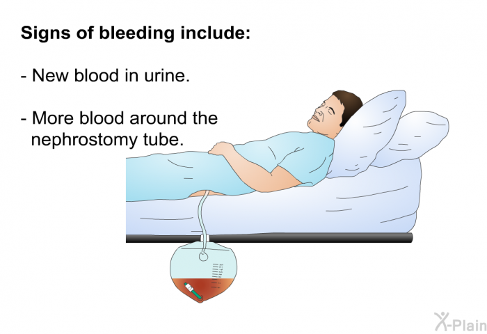 <B>Signs of bleeding include:</B>  New blood in urine. More blood around the nephrostomy tube.