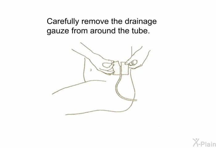 Carefully remove the drainage gauze from around the tube.
