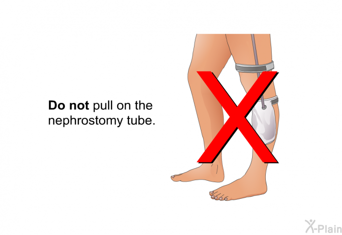 <B>Do not</B> pull on the nephrostomy tube.