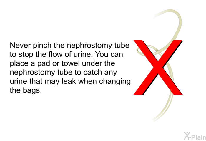 Never pinch the nephrostomy tube to stop the flow of urine. You can place a pad or towel under the nephrostomy tube to catch any urine that may leak when changing the bags.