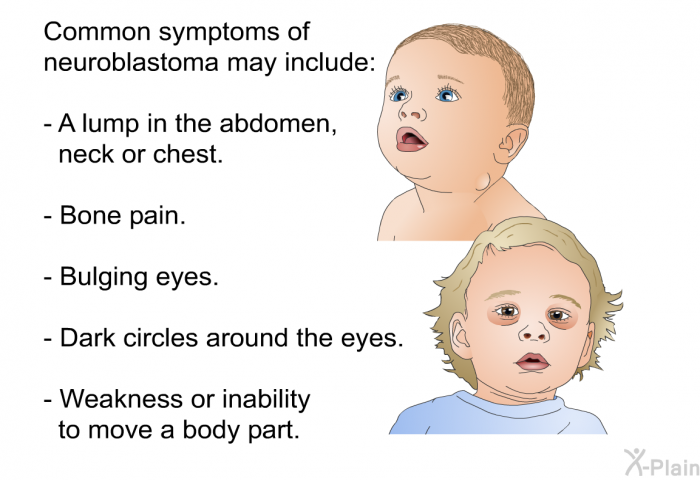 Common symptoms of neuroblastoma may include:  A lump in the abdomen, neck or chest. Bone pain. Bulging eyes. Dark circles around the eyes. Weakness or inability to move a body part.