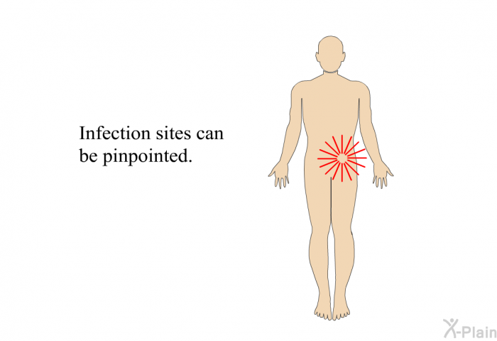 Infection sites can be pinpointed.