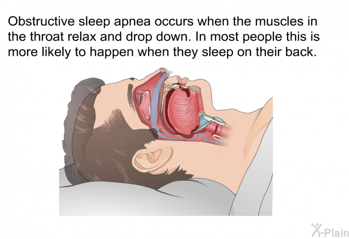 Obstructive sleep apnea occurs when the muscles in the throat relax and drop down. In most people this is more likely to happen when they sleep on their back.