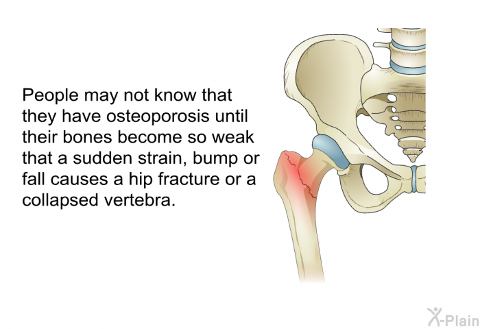 People may not know that they have osteoporosis until their bones become so weak that a sudden strain, bump or fall causes a hip fracture or a collapsed vertebra.