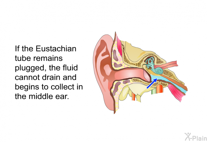 If the Eustachian tube remains plugged, the fluid cannot drain and begins to collect in the middle ear.