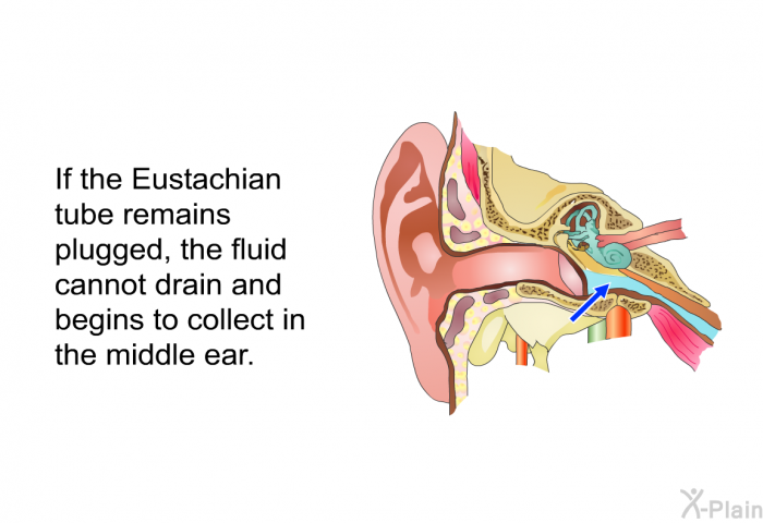 If the Eustachian tube remains plugged, the fluid cannot drain and begins to collect in the middle ear.