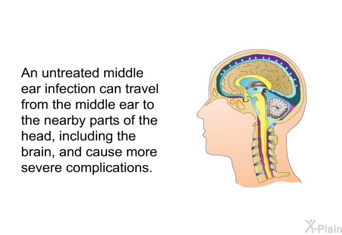 An untreated middle ear infection can travel from the middle ear to the nearby parts of the head, including the brain, and cause more severe complications.