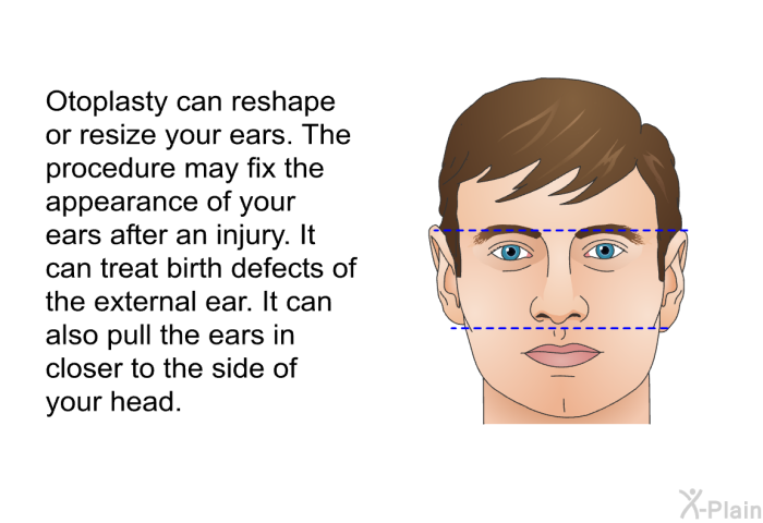 Otoplasty can reshape or resize your ears. The procedure may fix the appearance of your ears after an injury. It can treat birth defects of the external ear. It can also pull the ears in closer to the side of your head.