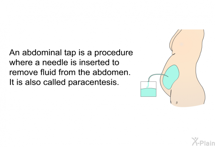 An abdominal tap is a procedure where a needle is inserted to remove fluid from the abdomen. It is also called paracentesis.