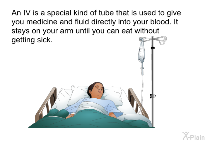 An IV is a special kind of tube that is used to give you medicine and fluid directly into your blood. It stays on your arm until you can eat without getting sick.