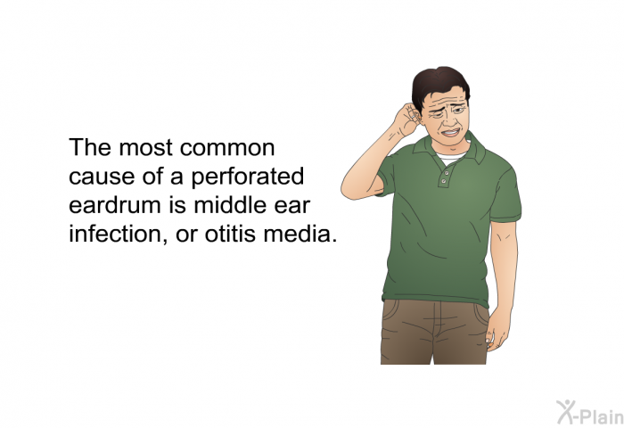 The most common cause of a perforated eardrum is middle ear infection, or otitis media.