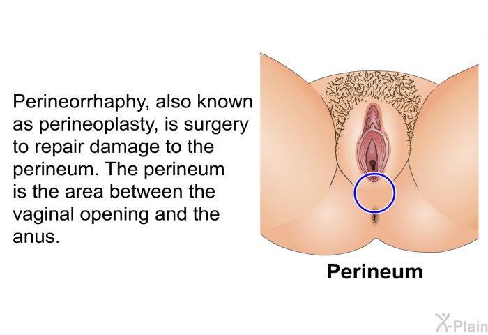 Perineorrhaphy, also known as perineoplasty, is surgery to repair damage to the perineum. The perineum is the area between the vaginal opening and the anus.