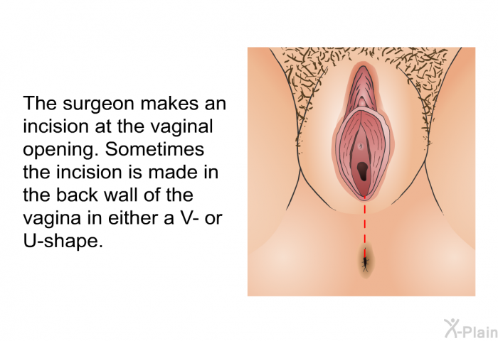 The surgeon makes an incision at the vaginal opening. Sometimes the incision is made in the back wall of the vagina in either a V- or U-shape.