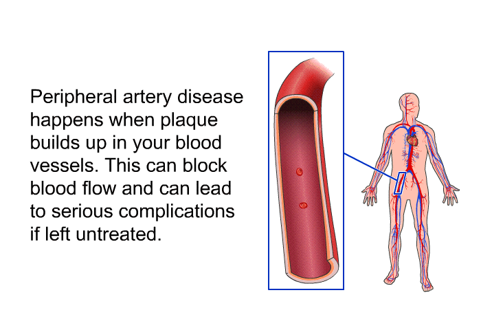 Peripheral artery disease happens when plaque builds up in your blood vessels. This can block blood flow and can lead to serious complications if left untreated.