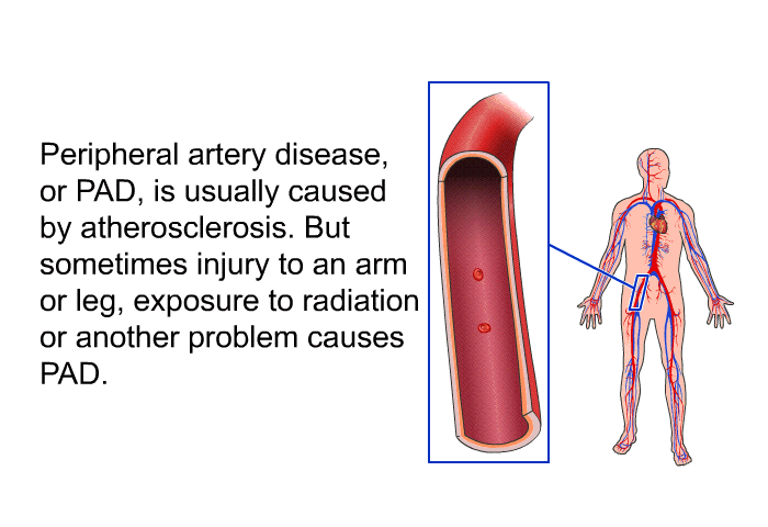 Peripheral artery disease, or PAD, is usually caused by atherosclerosis. But sometimes injury to an arm or leg, exposure to radiation or another problem causes PAD.