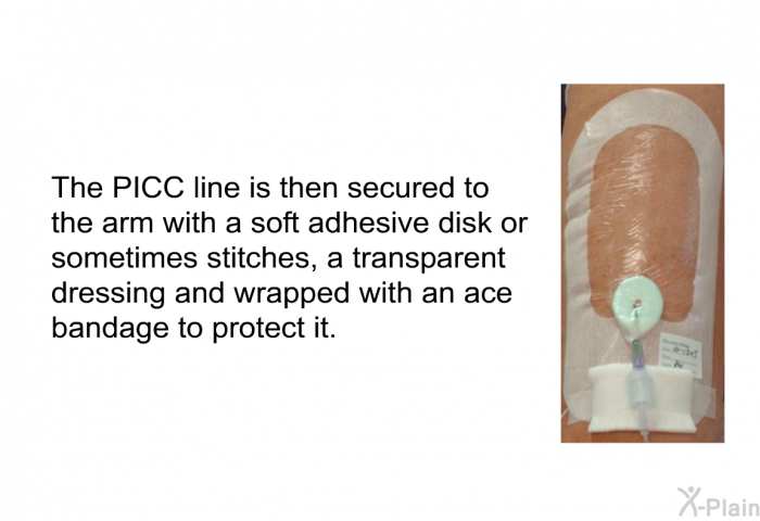 The PICC line is then secured to the arm with a soft adhesive disk or sometimes stitches, a transparent dressing and wrapped with an ace bandage to protect it.