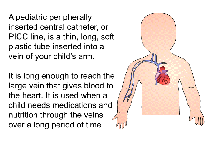 Peripherally Inserted Central Catheter (PICC Line)