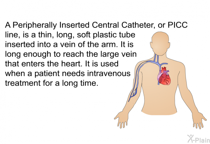 A Peripherally Inserted Central Catheter, or PICC line, is a thin, long, soft plastic tube inserted into a vein of the arm. It is long enough to reach the large vein that enters the heart. It is used when a patient needs intravenous treatment for a long time.