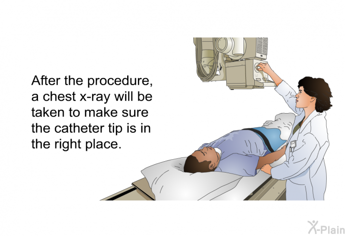 After the procedure, a chest x-ray will be taken to make sure the catheter tip is in the right place.