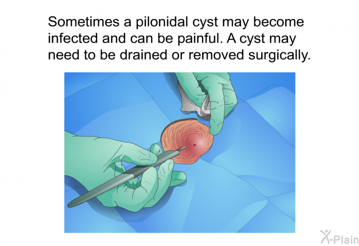 Sometimes a pilonidal cyst may become infected and can be painful. A cyst may need to be drained or removed surgically.