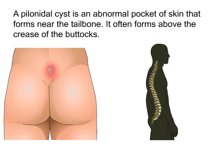 A pilonidal cyst is an abnormal pocket of skin that forms near the tailbone. It often forms above the crease of the buttocks.