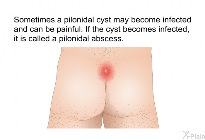 Sometimes a pilonidal cyst may become infected and can be painful. If the cyst becomes infected, it is called a pilonidal abscess.